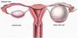 Comprendre le cancer de l ovaire - Institut Curie