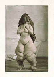 Image result for Elephantiasis