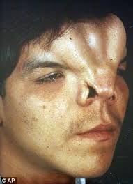 Before: This 1984 photo provided by Martin Oliva-Torres shows Oliva-Torre at age 24 with a severe craniofacial abnormality that severely impacted the ... - article-2402014-1B6A90D3000005DC-440_306x423