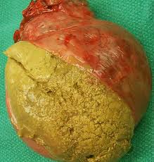 Image result for teratoma