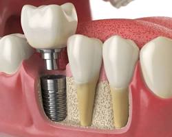 Dental implant