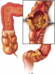 Infeksi Clostridium Difficile