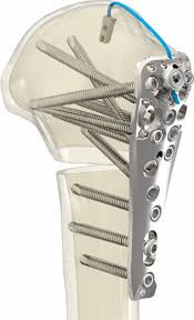 Biomechanical analysis of push–pull principle versus ...