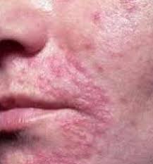 Znalezione obrazy dla zapytania candida na skórze