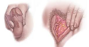 Resultado de imagen para ladillas genitales