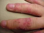 Dermatite atopique : quaposest-ce que caposest, comment la soigner