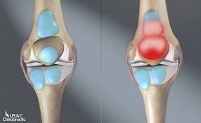 C&aacute;ch điều trị vi&ecirc;m đau khớp gối hiệu quả kh&ocirc;ng cần d&ugrave;ng thuốc