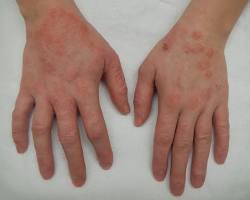 صورة علاج الأكزيما