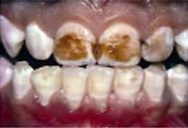 Znalezione obrazy dla zapytania Zęby uszkodzone przez fluor