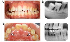 Résultat de recherche d'images pour "shovel shaped incisors"
