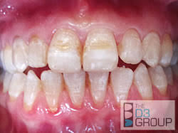 Image result for fluorosis