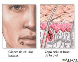 Resultado de imagen de CANCER DE PIEL MEDLINEPLUS