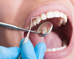 Image of Dụng cụ cạo vôi răng nha khoa thực tế