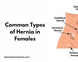 Umbilical hernia in the body