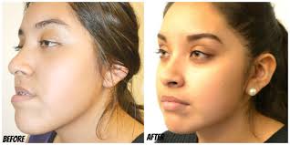 Image result for jaw surgery