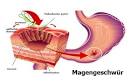 Helicobacter pylori