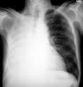 Atelectasis of lung