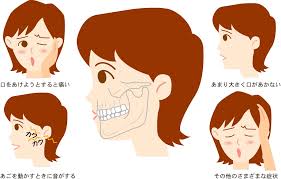 「顎関節症」の画像検索結果
