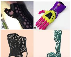 3D printing prosthetics and orthotics