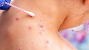 Detectan los primeros casos de viruela símica en 2026 en Yucatán