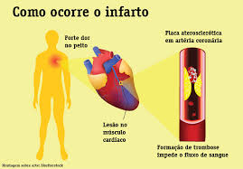 Resultado de imagem para INFARTO