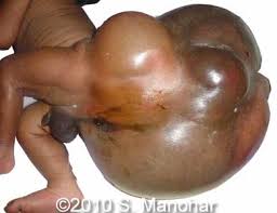 Image result for teratoma