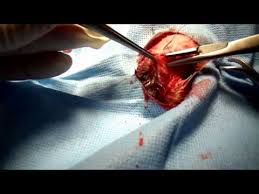 Image result for eyeball enucleation cattle