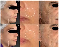 Image of Carbon laser treatment skin texture