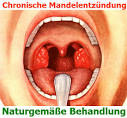 Mandelentzündung (Angina tonsillaris) Apotheken Umschau