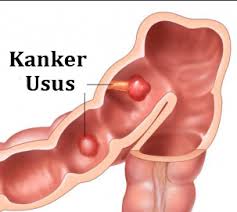 Image result for kanker