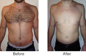 Image result for hair removal before and after