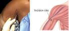 Biceps Tenodesis - Surgical Procedure