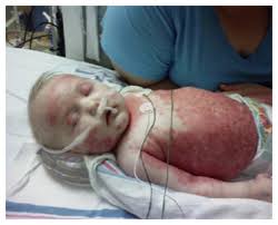 Image result for newborn diaper rash