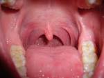 Die Syphilis der Schleimhaut der Mund-, Rachen-, Nasen