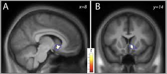 Image result for ventral striatum