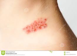 Image result for "Herpes Zoster"