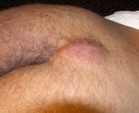 Znalezione obrazy dla zapytania Cysta