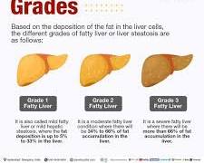 Image de Grade 2 fatty liver