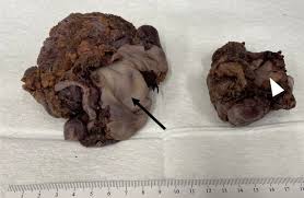 Gross pathology specimens of the pelvic mature cystic ...