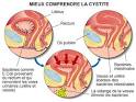 MONURIL - Fosfomycine - Posologie, Effets secondaires, Grossesse