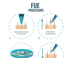 Image of FUE hair transplant process