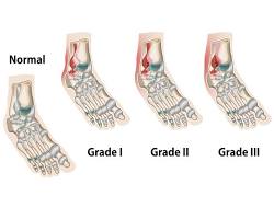 Image of Grade 2 ankle sprain