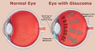 Resultado de imagen para glaucoma