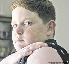 Freckle-faced Corey Halpin, 13, shows off his big scar at his Hanover Park, Ill., home on Monday, April 18, 2005, a reminder of surgery three years ago to ... - 1044902