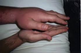 Résultat de recherche d'images pour "copperhead bites"