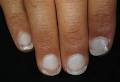 Ongle blanc maladie