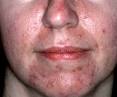 Rosacea - en folkesykdom