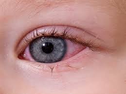 Résultat de recherche d'images pour "eye infection"