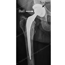 Image result for total hip replacement components
