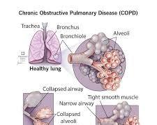 Image of COPD lungs